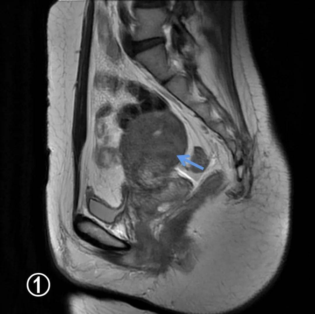 奥赛康：创新药ASKC202注册性临床III期研究完成首例患者给药