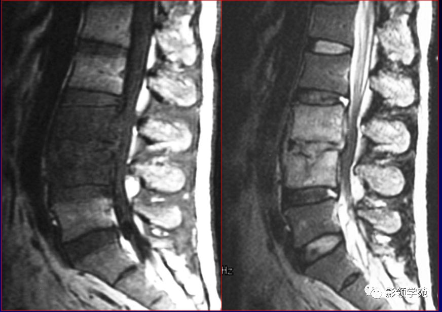 三友医疗获得发明专利授权：“颈椎椎管扩大成型支架及植入设备”