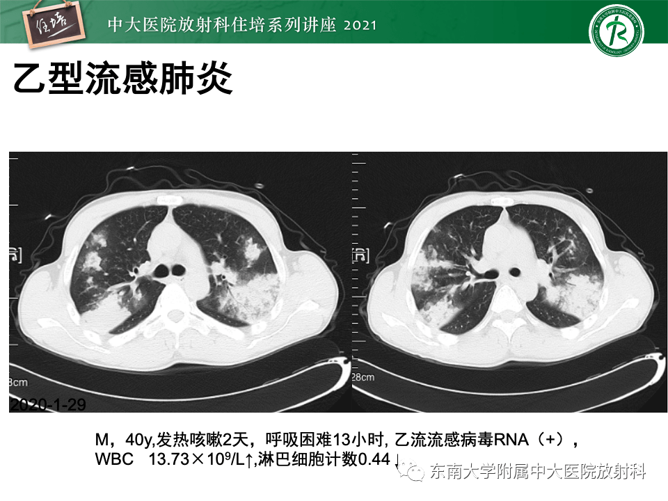 英国住院医师流感高峰期启动罢工