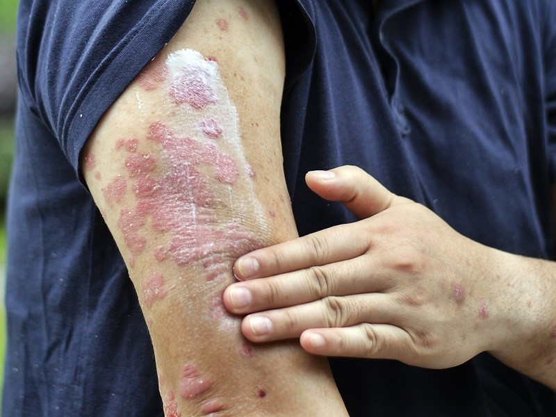 我武生物：获得狗毛皮屑点刺液药物临床试验补充申请批准通知书